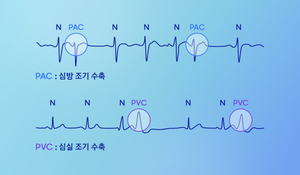 PAC(심방 조기 수축)와 PVC(심실 조기 수축) 등의 이소성 박동 감지